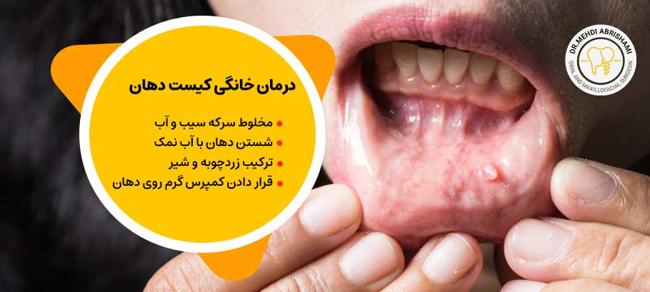 آیا می‌توان با درمان خانگی کیست دهان را از بین برد؟