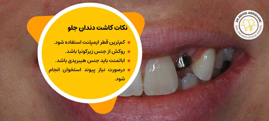 نکات مهم در کاشت ایمپلنت دندان جلو