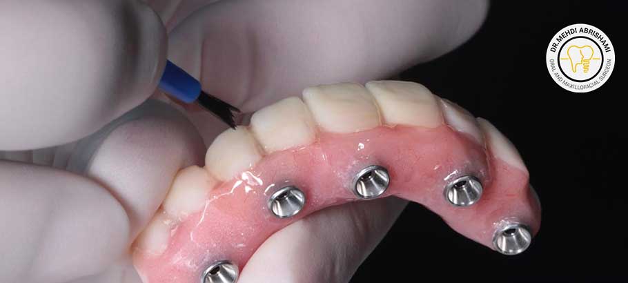 مراحل کاشت دندان به روش all on x