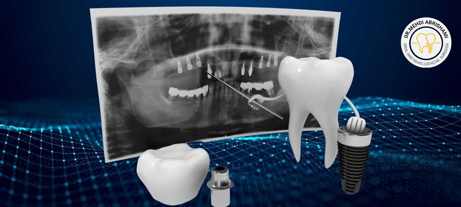 ایمپلنت‌ دندان چیست؟