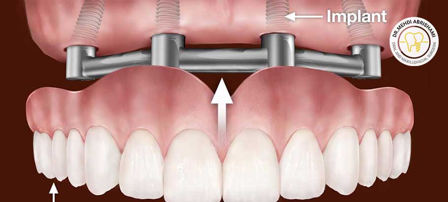 کدام پزشک یا متخصص را برای انجام کاشت دندان به روش all on x در اصفهان انتخاب کنیم؟