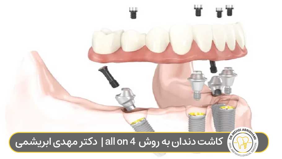 کاشت دندان به روش all on 4 در اصفهان | دکتر مهدی ابریشمی
