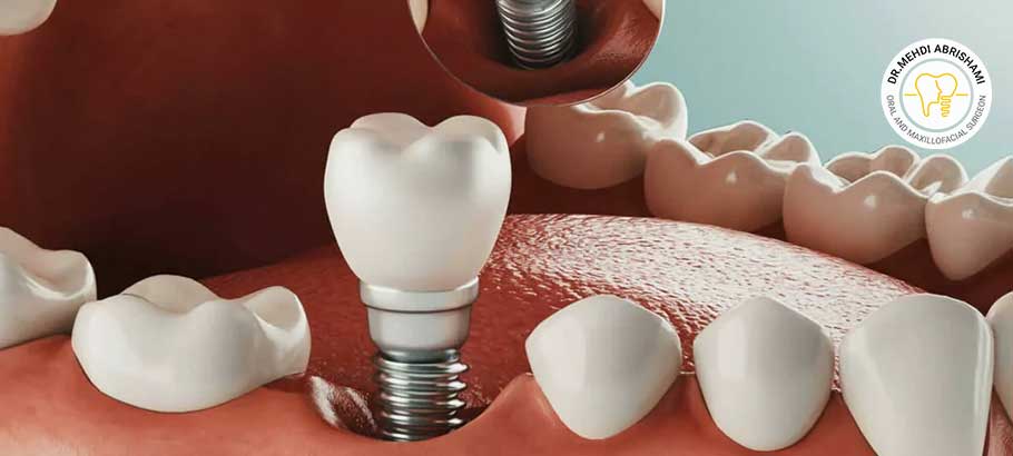 اصلی‌ترین علت شل‌شدن روکش ایمپلنت دندان
