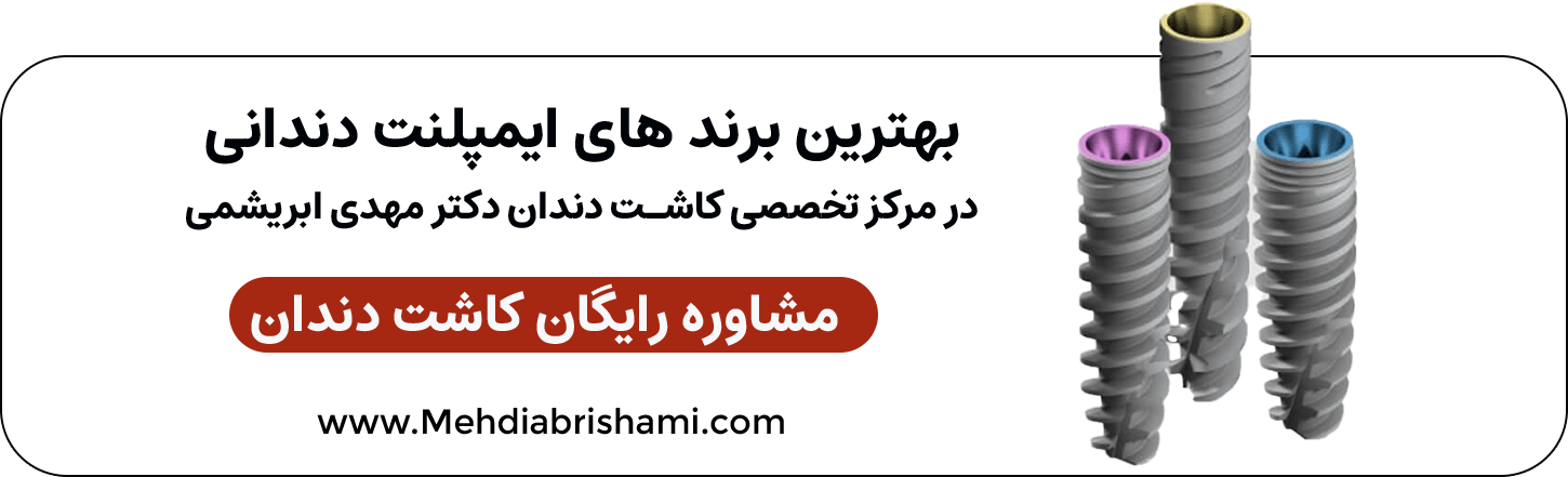 برای مشاوره رایگان کاشت دندان در اصفهان تماس بگیرید.