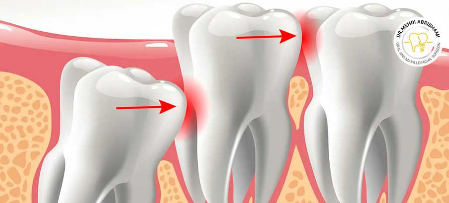 عوارض عدم جراحی دندان عقل