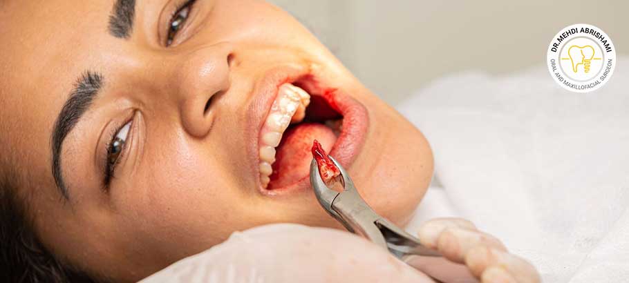 علت جراحی دندان عقل چیست؟