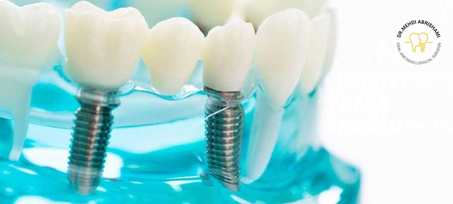 عوامل مضر و مؤثر در کاهش طول عمر ایمپلنت دندان