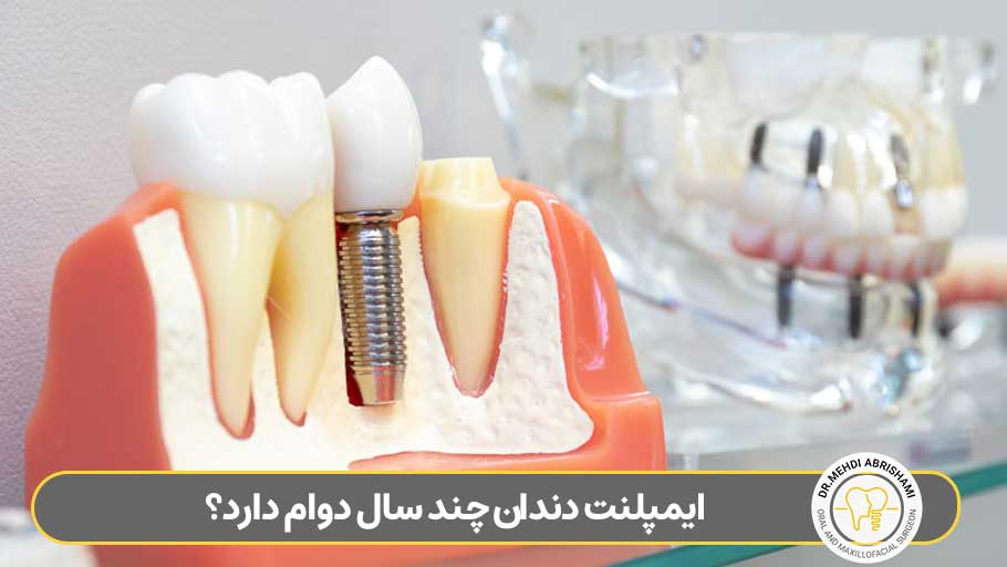 ایمپلنت دندان چند سال دوام دارد؟