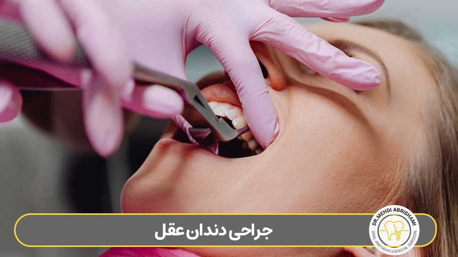 جراحی دندان عقل در اصفهان