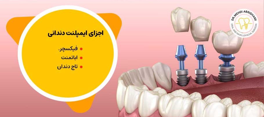 اجزای ایمپلنت دندانی