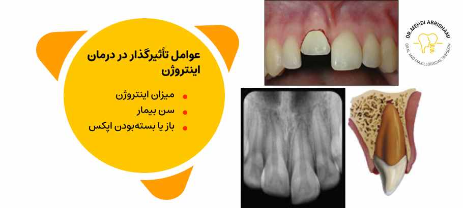 عوامل تأثیرگذار در درمان اینتروژن