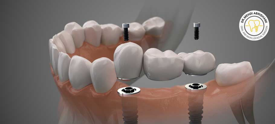 تعداد ایمپلنت لازم برای کاشت دندان