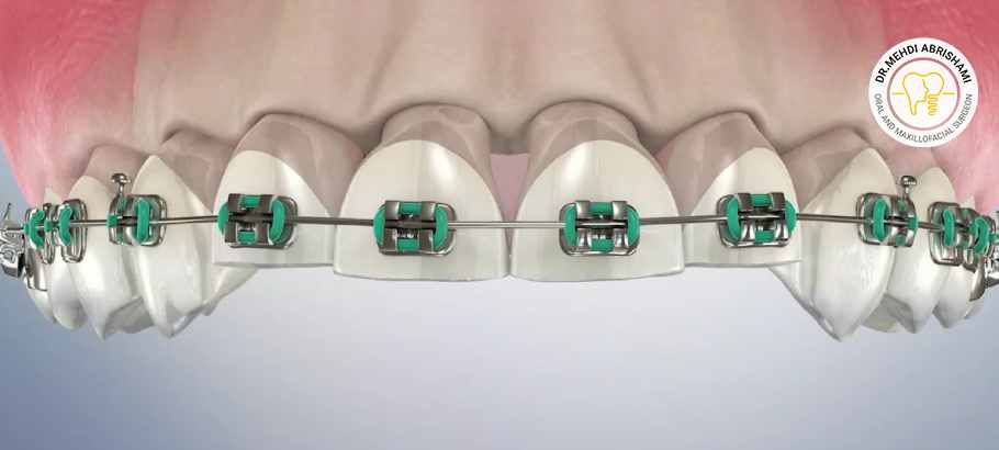درمان اینتروژن دندان با ارتودنسی  
