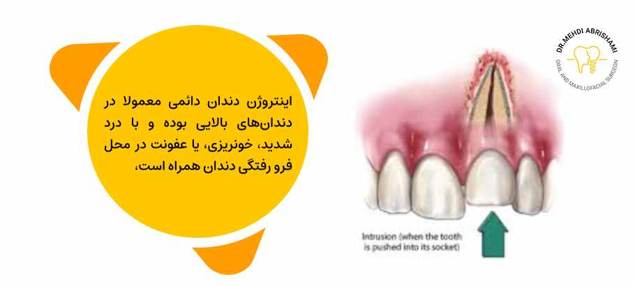 Permanent tooth intrusion