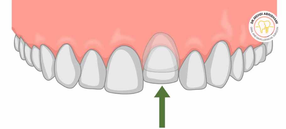 اینتروژن دندان (intrusion) چیست؟