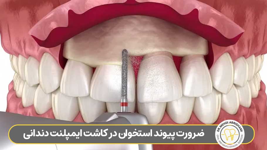 ضرورت پیوند استخوان در کاشت ایمپلنت دندانی