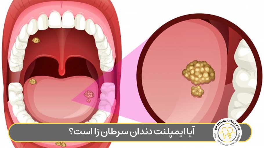 آیا ایمپلنت دندان سرطان زا است؟