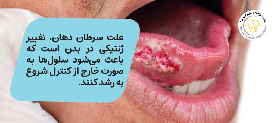 علت اصلی سرطان دهانی چیست؟