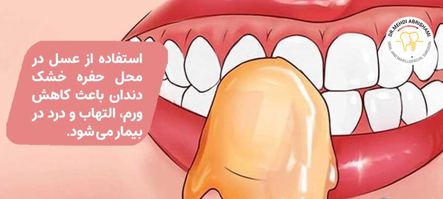 درمان خانگی حفره خشک دندان
