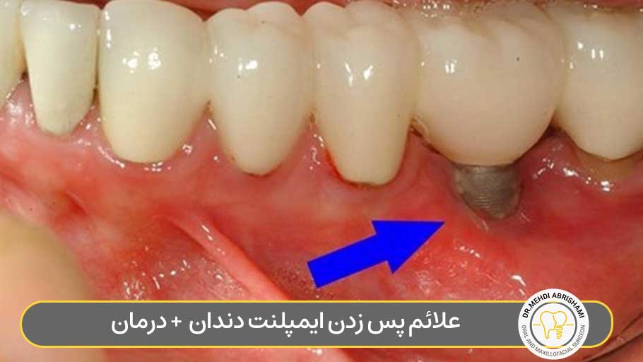 علائم پس زدن ایمپلنت دندان