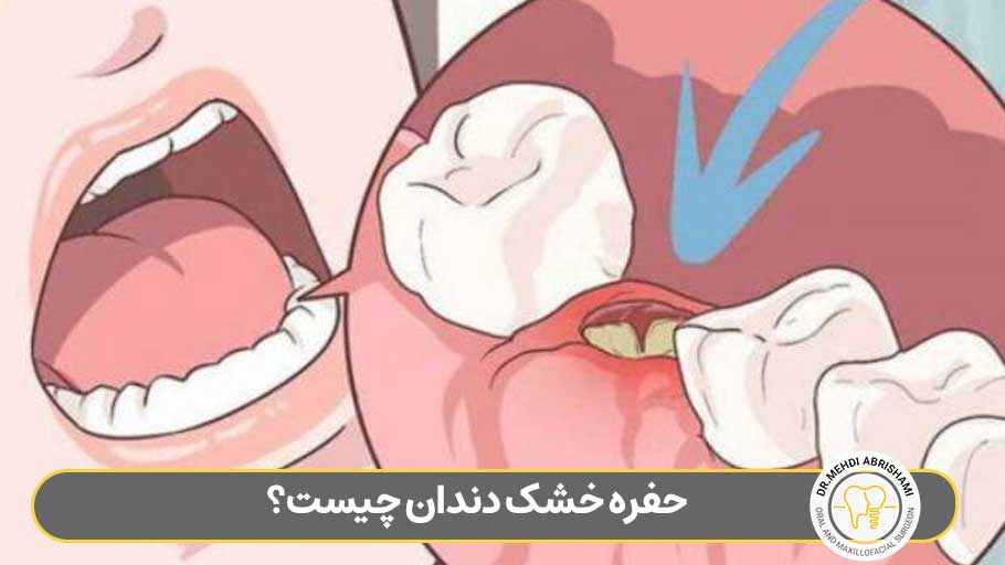 حفره خشک دندان چیست؟ (تشخیص+علائم+درمان)