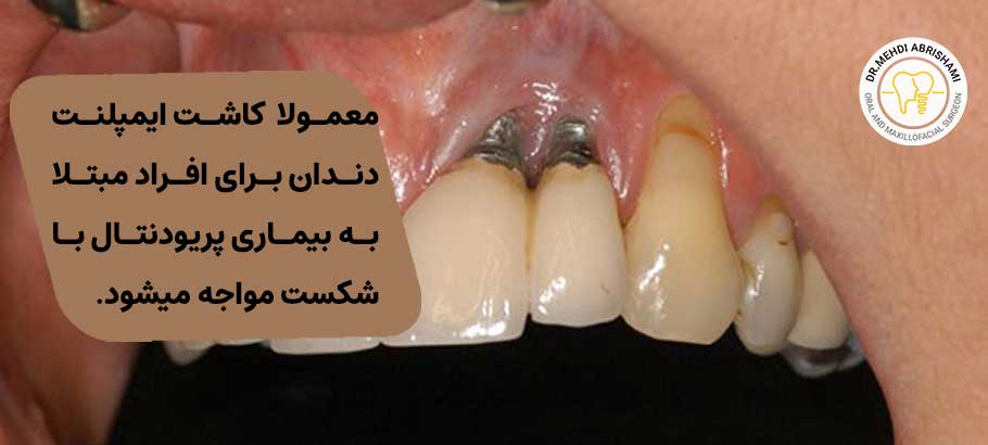 علت پس زدن ایمپلنت های دندانی چیست؟