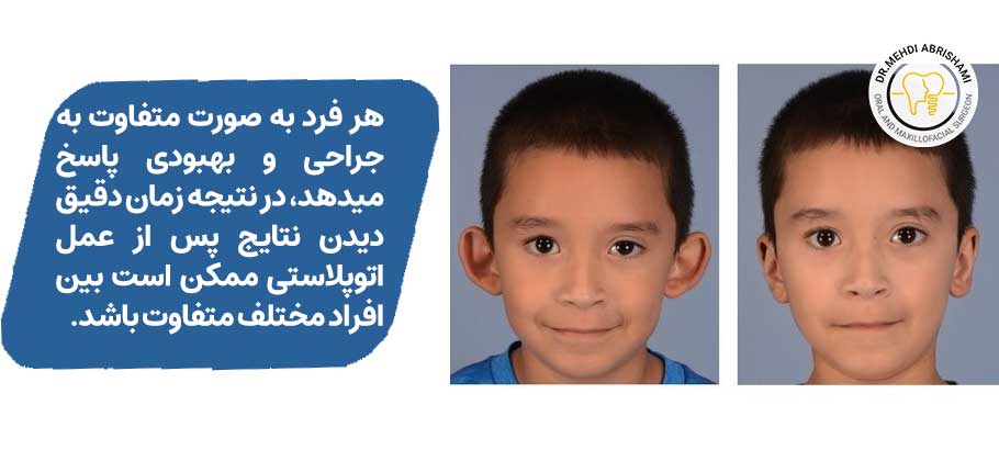 نتیجه عمل اتوپلاستی چند روز بعد از عمل مشخص میشود؟