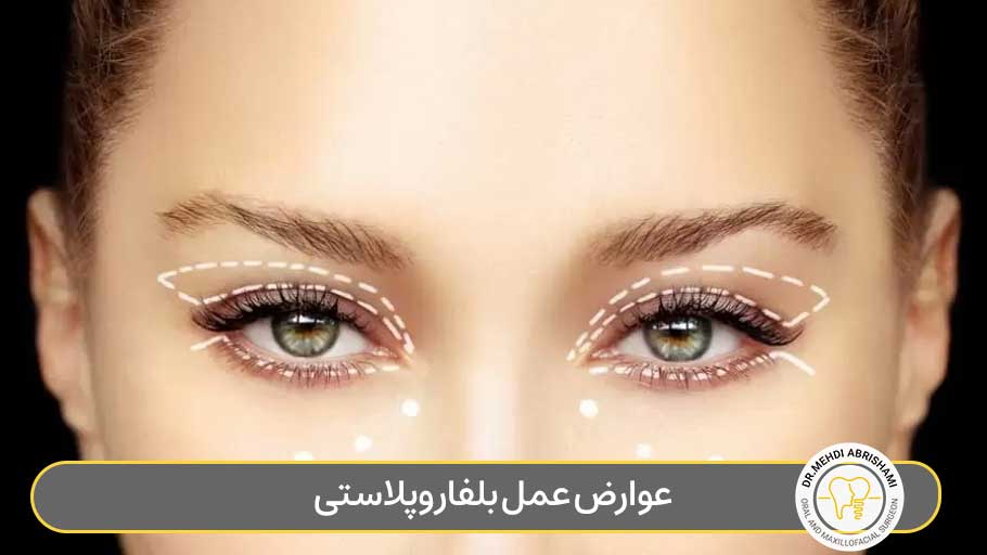 عوارض عمل بلفاروپلاستی چشم
