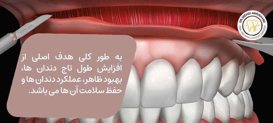 هدف از افزایش طول تاج دندان چیست؟