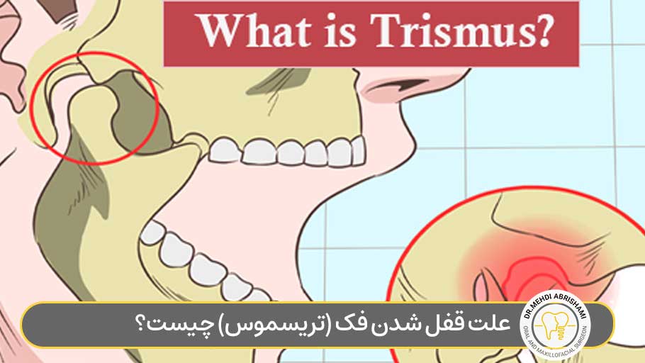 قفل شدن فک، قفل شدن دهان،تریسموس (Trismus) یا قفل فک چیست؟