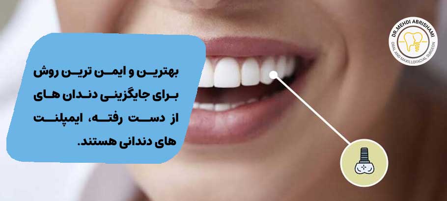کاشت ایمپلنت دندان، جایگزینی برای دندان از دست رفته (Dental Implant)