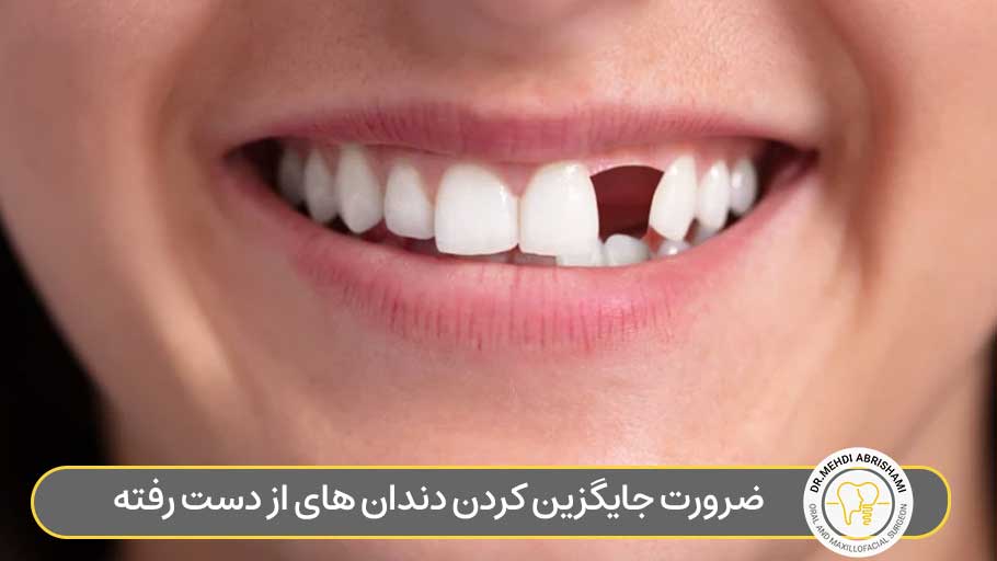 ضرورت جایگزین کردن دندان های از دست رفته چیست؟