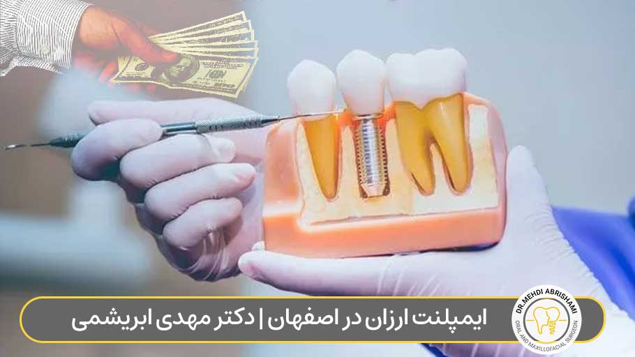 ایمپلنت ارزان در اصفهان