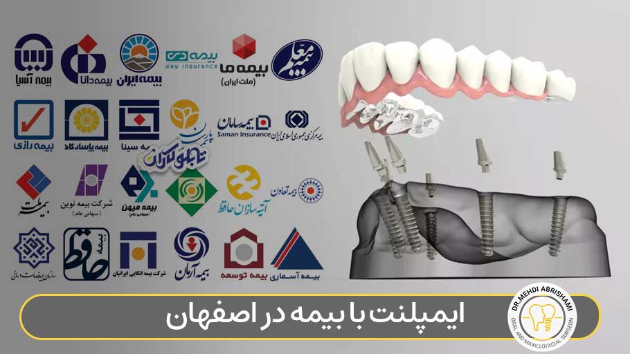 ایمپلنت با بیمه در اصفهان