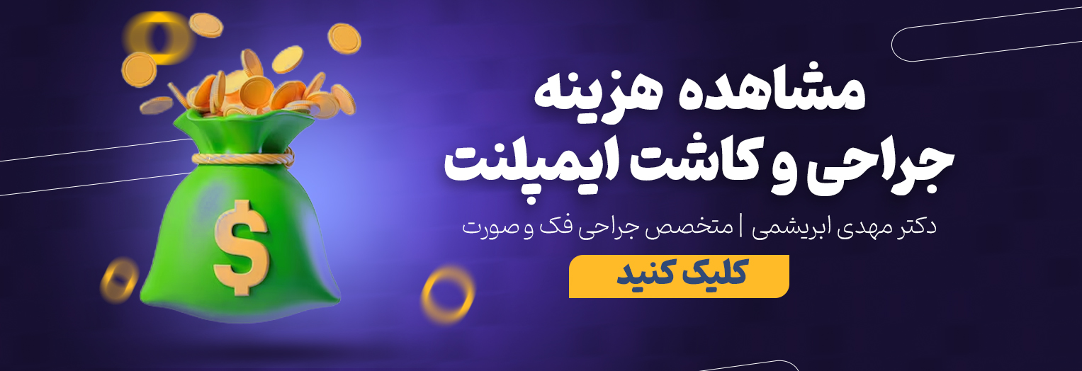 قیمت ایمپلنت در اصفهان