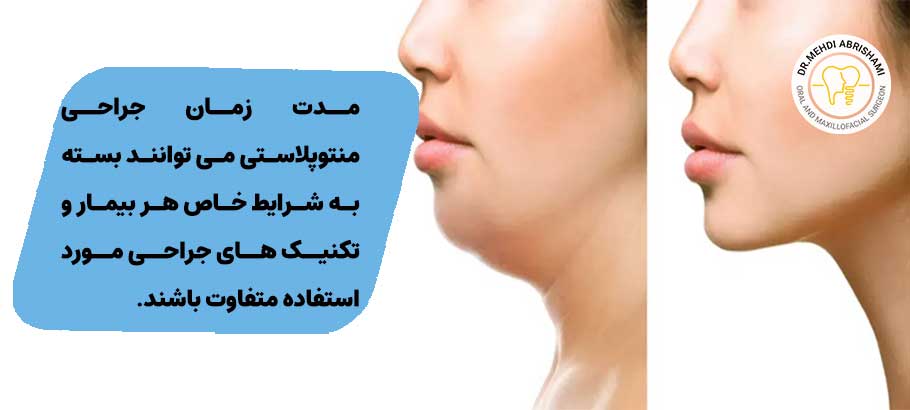 جراحی منتوپلاستی چقدر زمان می‌برد؟