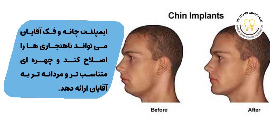 ایمپلنت چانه و فک آقایان