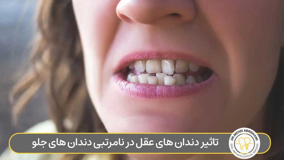 تاثیر دندان های عقل در نامرتبی دندان های جلو
