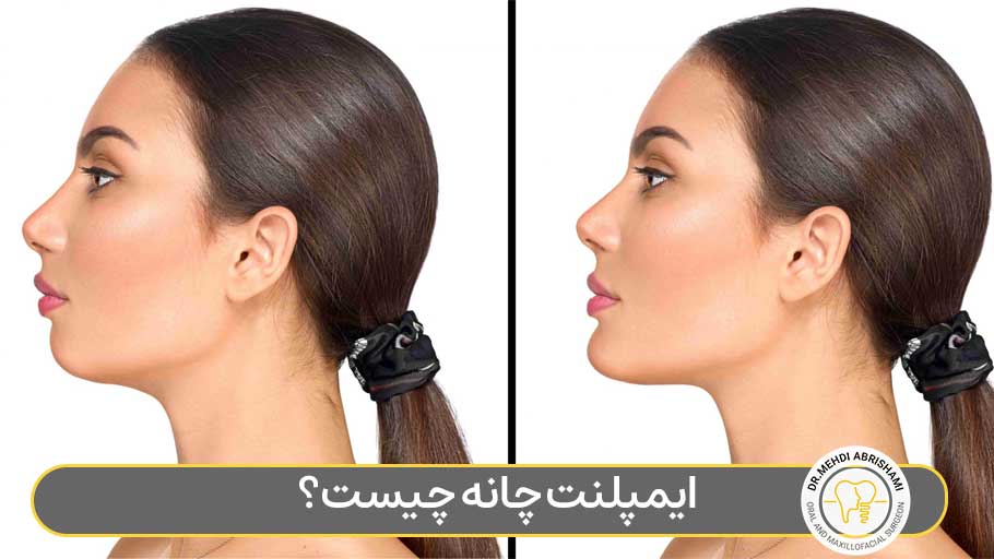 ایمپلنت چانه چیست؟