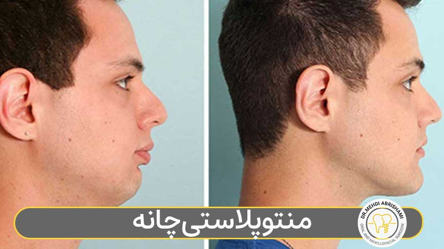 منتوپلاستی چانه