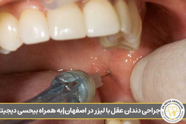 جراحی دندان عقل با لیزر در اصفهان|به همراه بیحسی دیجیتال