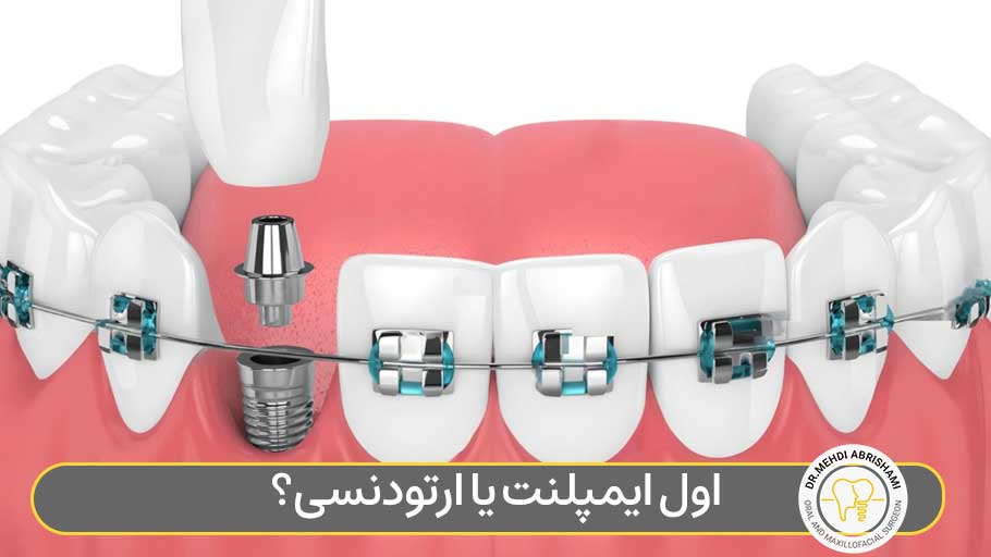 اول ایمپلنت یا ارتودنسی؟