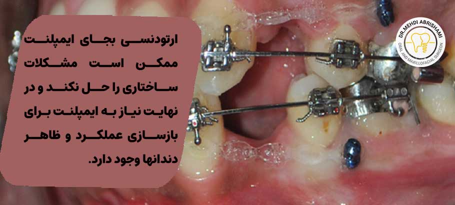 ارتودنسی بجای ایمپلنت