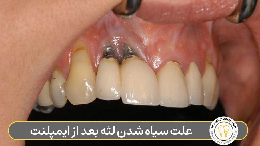 علت سیاه شدن لثه بعد از ایمپلنت