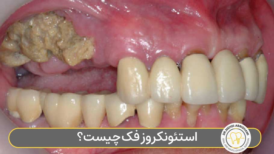 استئونکروز فک چیست؟