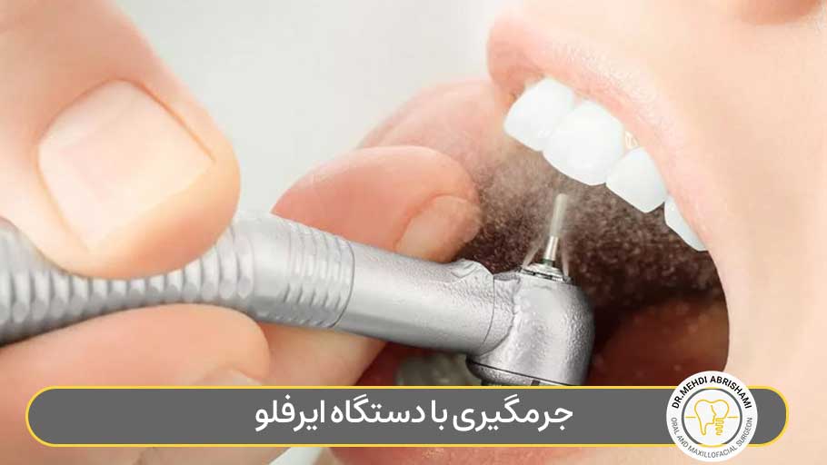 جرمگیری با دستگاه ایرفلو