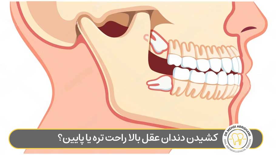 کشیدن دندان عقل بالا راحت تره یا پایین؟