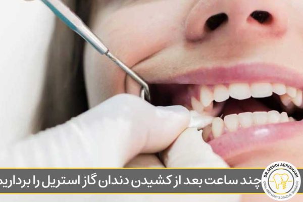 چند ساعت بعد از کشیدن دندان گاز استریل را برداریم؟