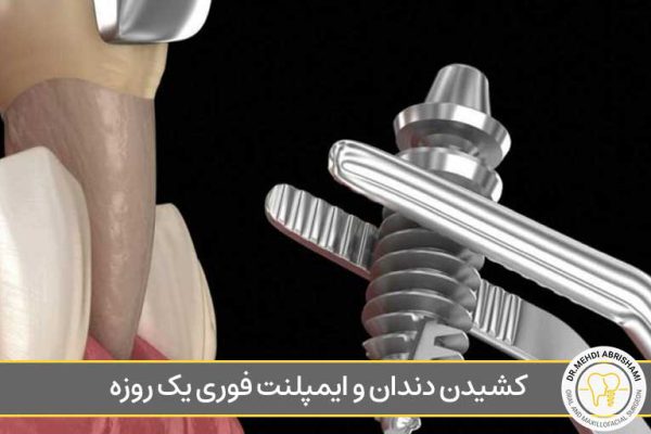 کشیدن دندان و ایمپلنت فوری یک روزه