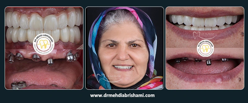 نمونه جراحی و کاشت ایمپلنت در اصفهان در مرکز کاشت ایمپلنت دکتر مهدی ابریشمی